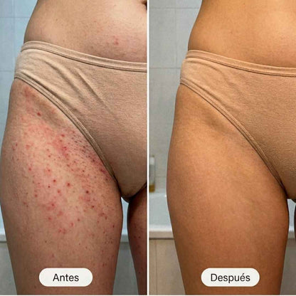 Nurealy™ Aceite Regenerador Post-Depilación