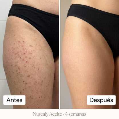 Nurealy™ Aceite Regenerador Post-Depilación